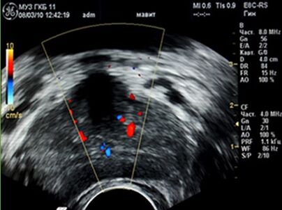 L'échographie a montré des foyers d'inflammation dans la prostate. 