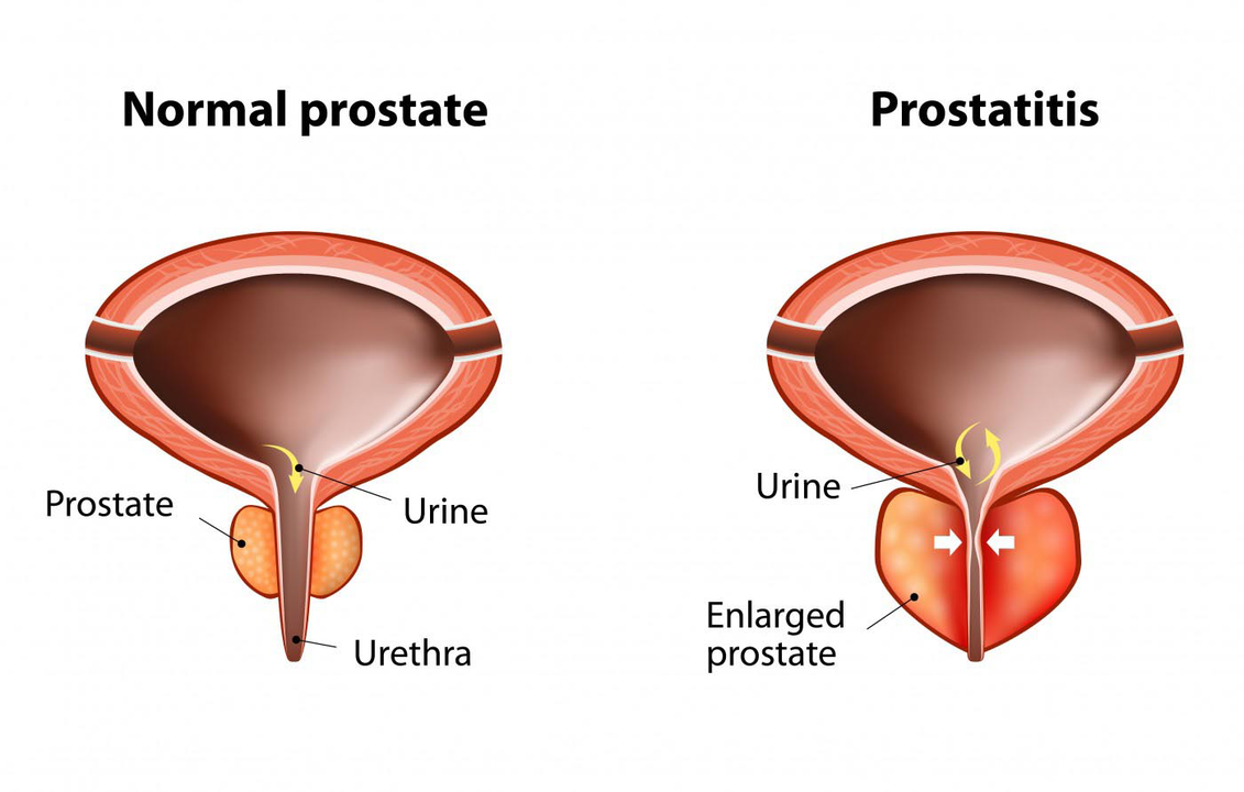 Prostate normale d'un homme en bonne santé et inflammation de la prostate avec prostatite.